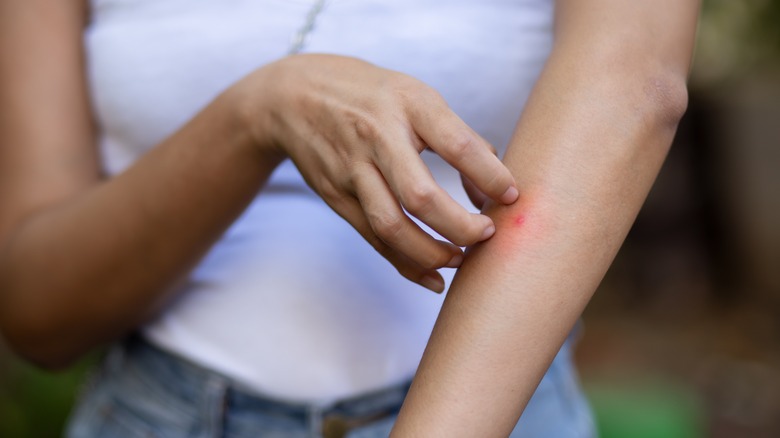 Woman scratching a mosquito bite